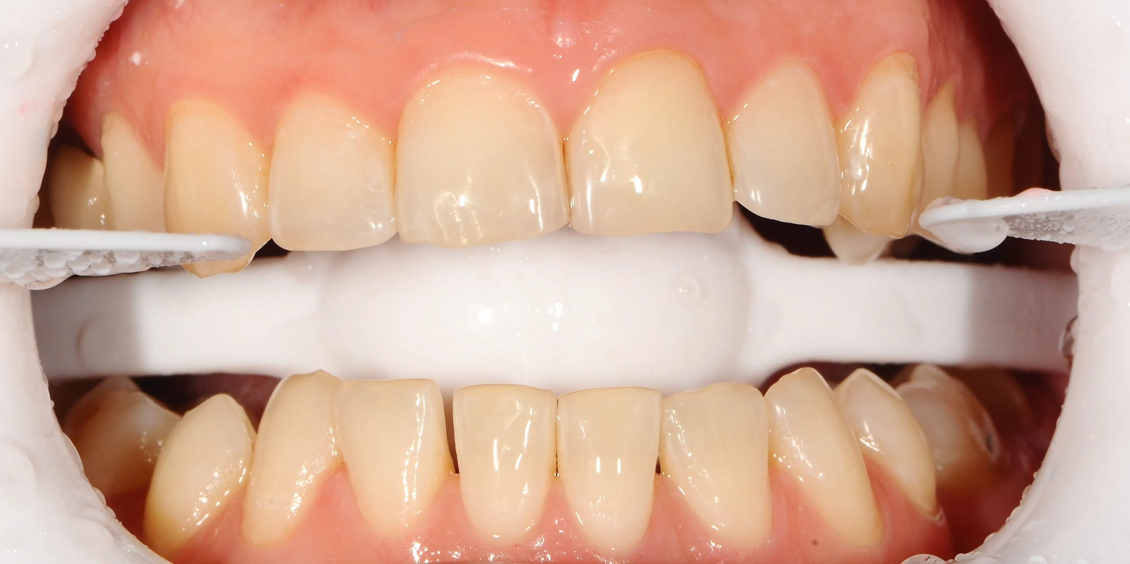 Отбеливание